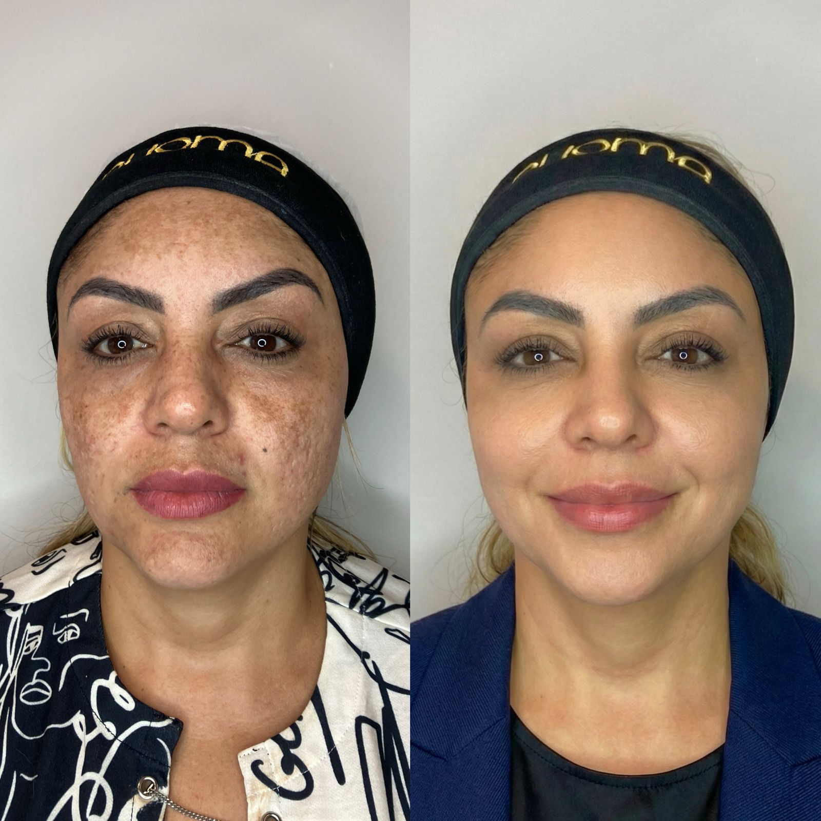 Resultado de tratamento Neferpeel - cliente 1