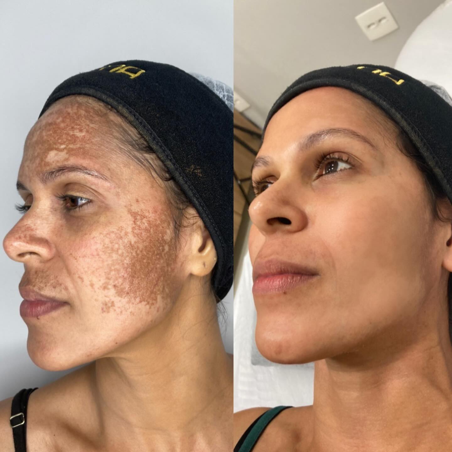 Resultado de tratamento Neferpeel - cliente 2