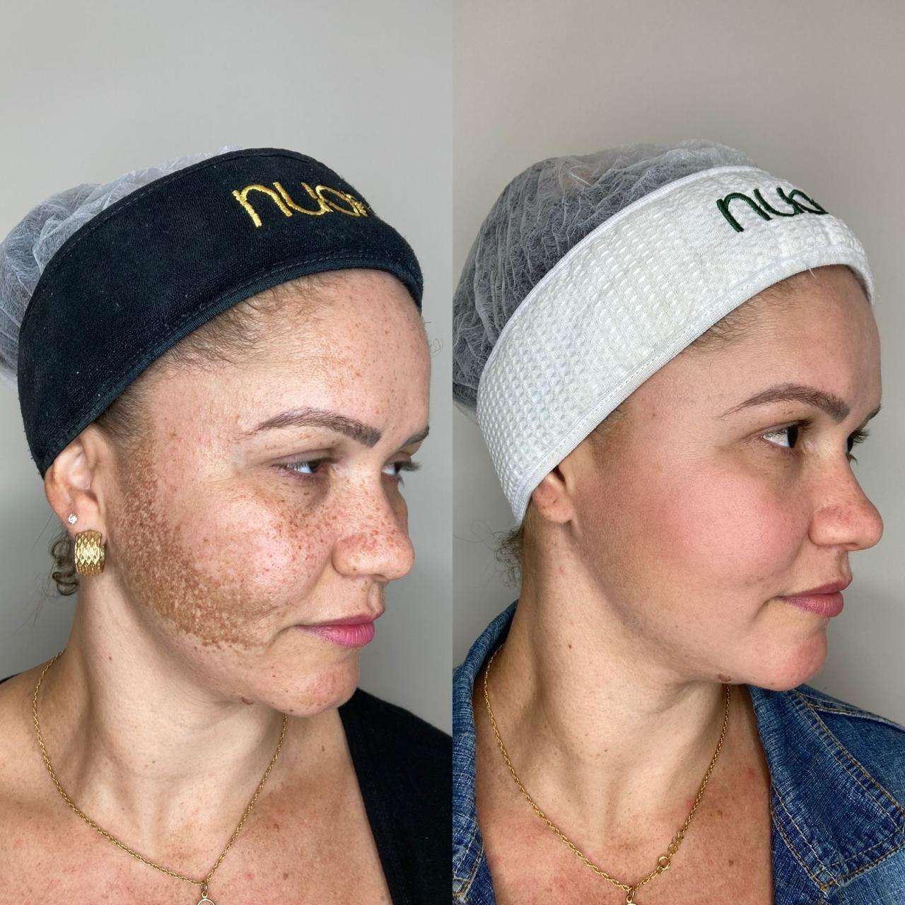 Resultado de tratamento Neferpeel - cliente 3