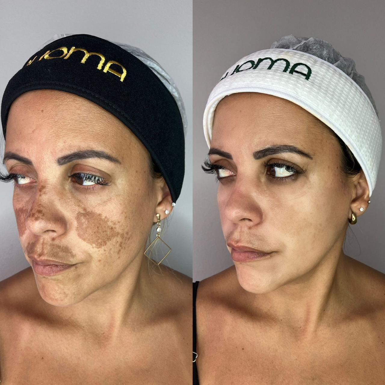 Resultado de tratamento Neferpeel - cliente 4